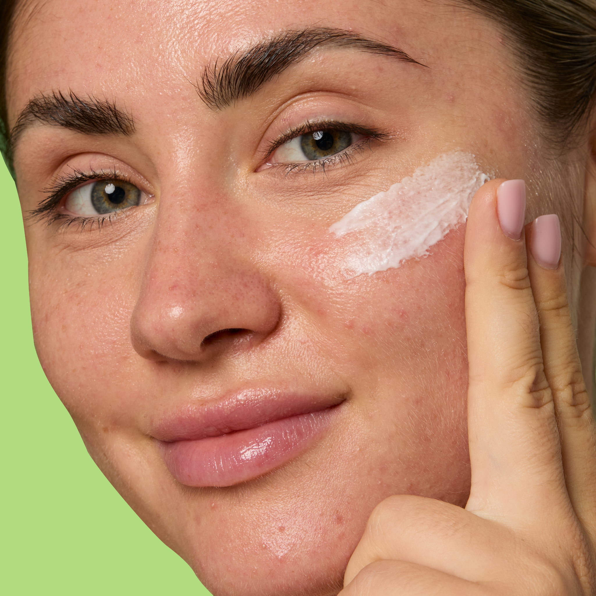 10% Azelaic Acid Treatment Y2