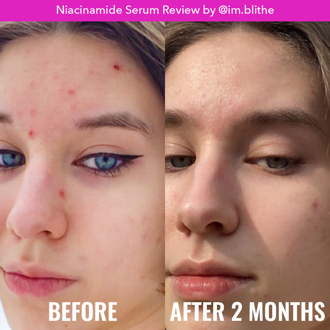 Niacinamide Serum Z4